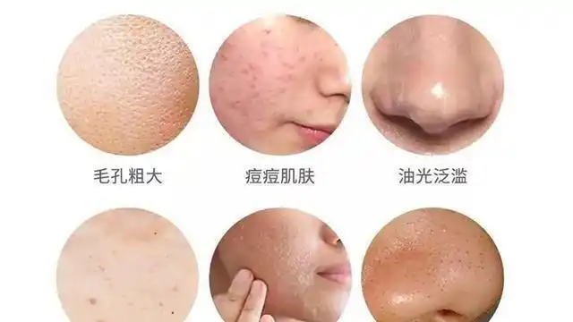 男性也有干性,中性,油性,混合性皮肤特质,应如何护肤(油性)