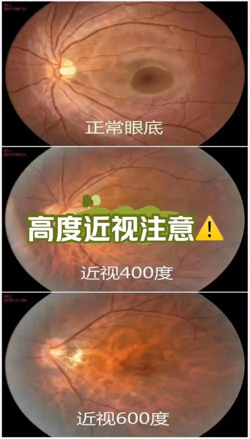 高度近视患者保护眼底可从以下几个