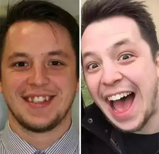 "昨天摘掉了我的牙套,三年前后的对比是巨大的.