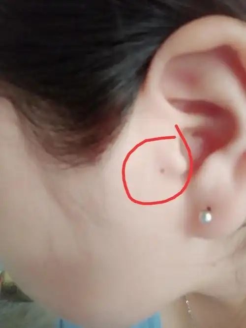 请大家看下这里长痣好不好,右耳朵