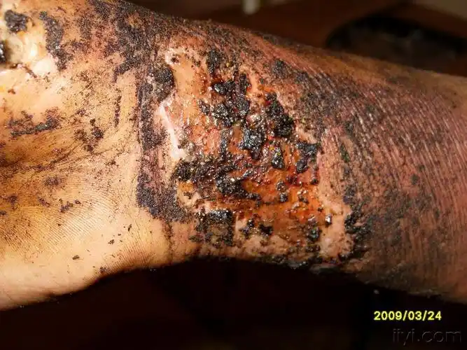 前臂电烧伤《附图片》