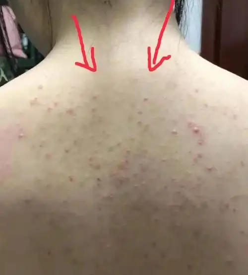 根除后背痘不花冤枉钱掌握这几个方法脓包粉刺在家洗洗就掉