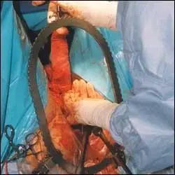 变性手术过程图示(男变女)