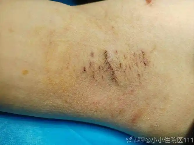 小切口腋臭切除术案例分享各位大佬是怎么做的呢