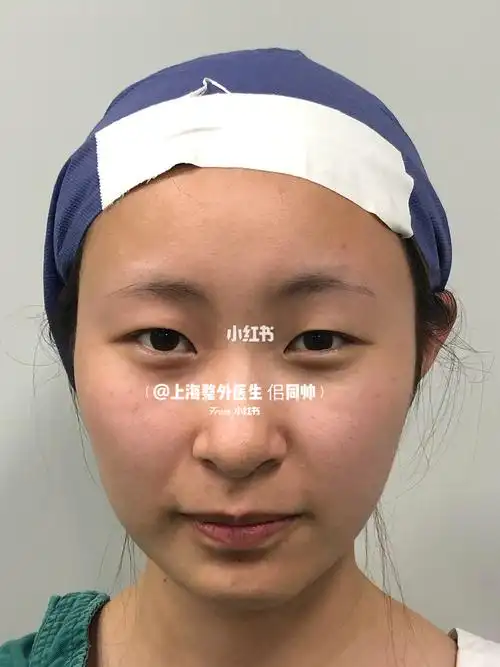 眼皮贴",这个也是导致现在很多学生年纪轻轻眼皮就松弛下垂的原因之一