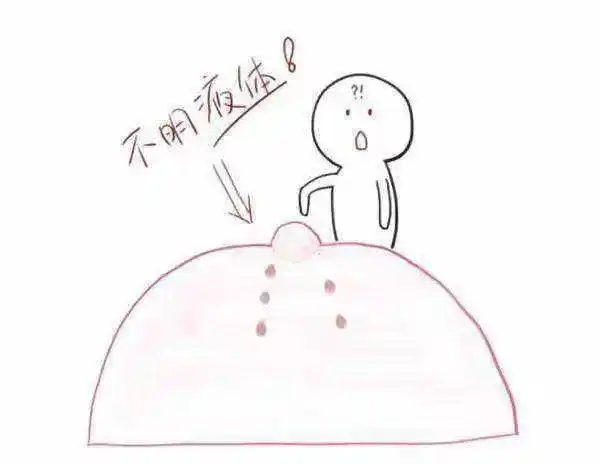 乳头溢液咋回事别慌郑州市三院甲状腺乳腺外科来帮忙