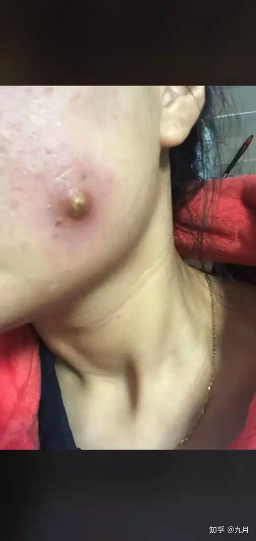 火疖子 皮脂腺囊肿 粉瘤