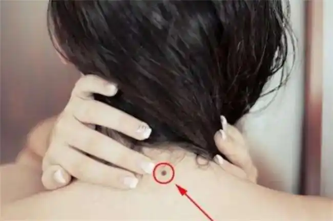 女人后背有痣命苦是真的吗 - 匠子生活