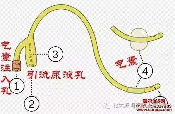 老婆狠拔导尿管,老公下身血流成河