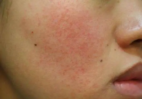 皮肤管理|针对角质层薄,红血丝的5种管理方法