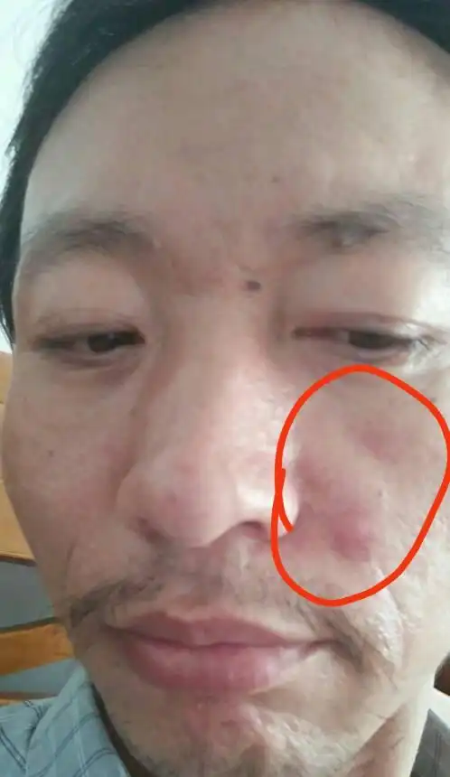 我脸上这是什么我脸上长一个红疙瘩,这是毛囊炎吗,网上加老师专家