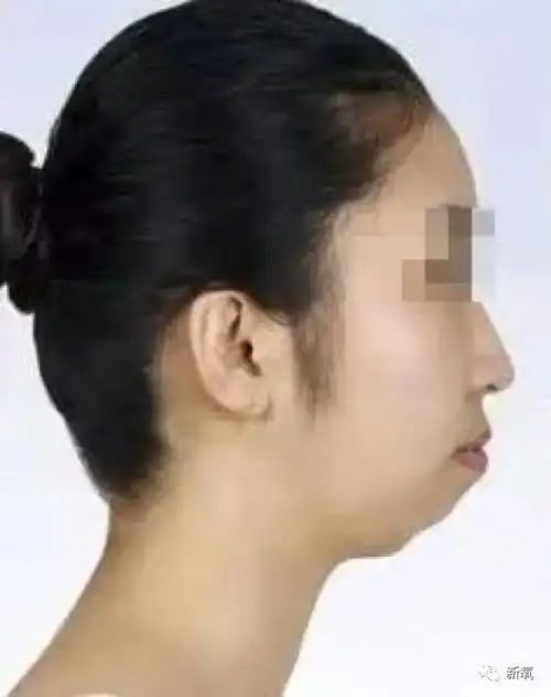 下颌线发育不良的情况,我们常说的是下颌后缩.