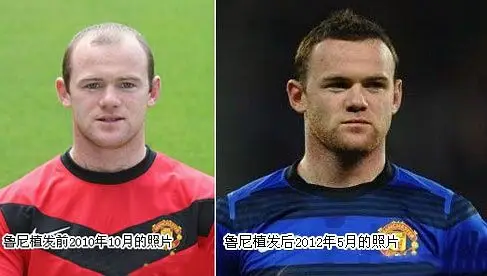 鲁尼植发前后对比图