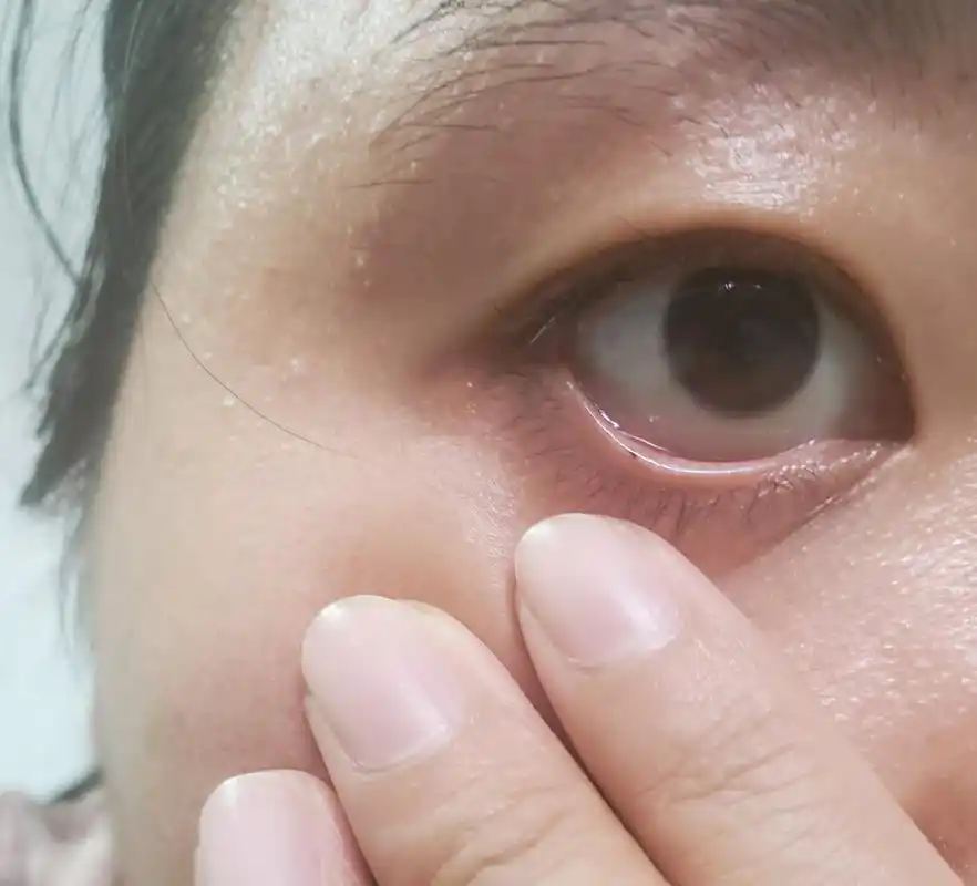 下眼睑长了痣(第五张图慎点) 请忽略我的烂皮肤 去年有一天照镜子