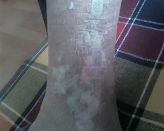 湿疹,神经性皮炎,过敏性皮炎,老年瘙痒症的 诊断和治疗 - 皮肤及性传