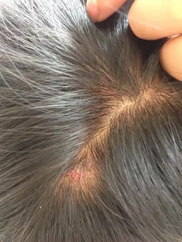 2013-11-03 李龙 医师 头皮长疙瘩,6年了,说是毛囊炎,挠下的死皮中间