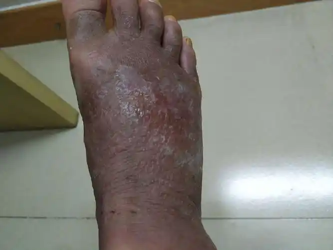 脚扭伤后用药不慎引起接触性皮炎