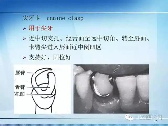 【多图】可摘局部义齿-卡环的种类
