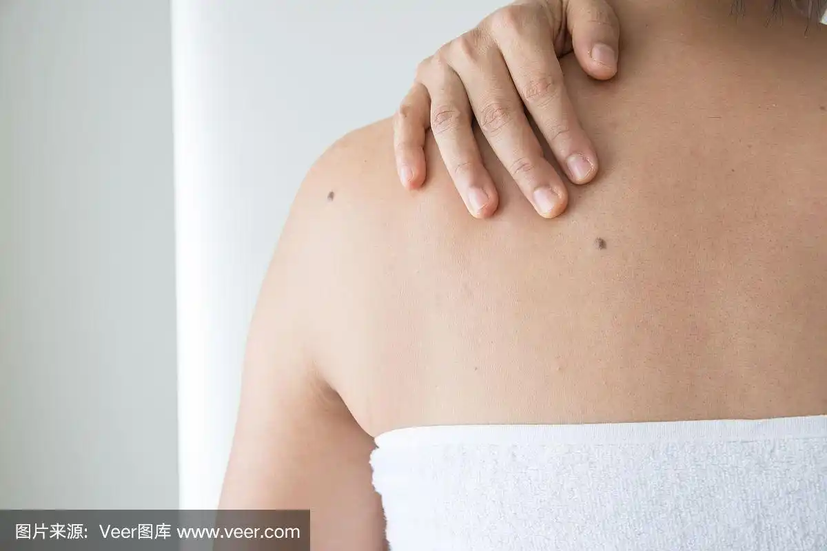 女人皮肤上的痣