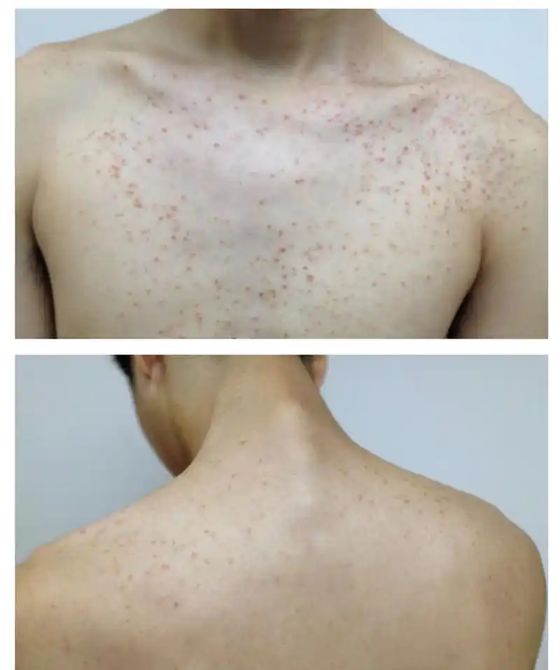 常见的毛囊炎,有细菌和真菌,2种.