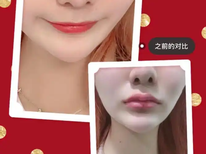 玻尿酸丰嘟嘟唇的恢复时间介绍:玻尿酸注射丰唇_圈子-新氧美容整形