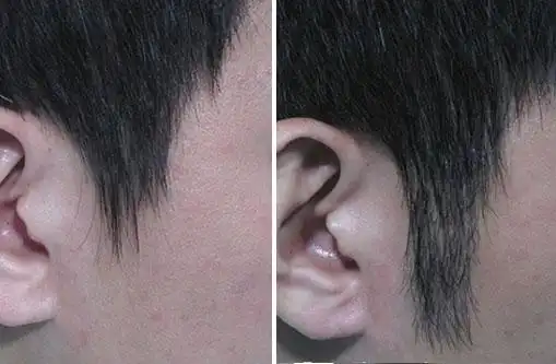 美莱鬓角移植术_北京鬓角移植_北京美莱医疗美容医院