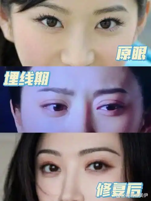 景甜终于修复双眼皮了!