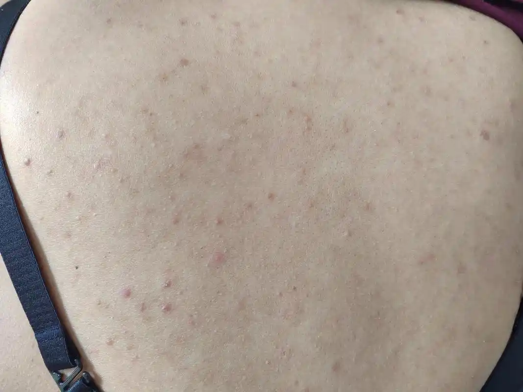 前胸后背的毛囊炎症状.考虑马拉色菌感染引起的传染性皮肤病.