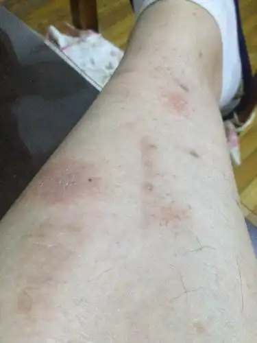 内科 免疫科 红斑狼疮 → 小腿出现一块一块的红斑请医生看看是什么情