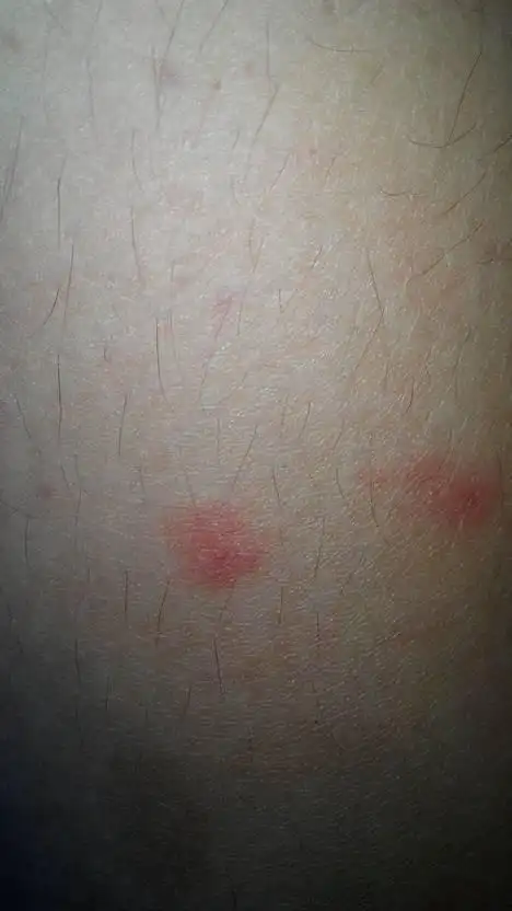 是这样的 我一回到农村老家身上就会出现这样的红点,非常痒,但是一