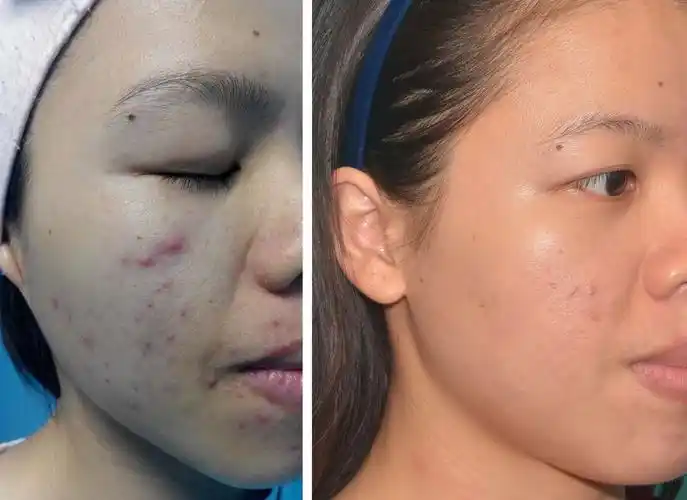 祛痘,祛痘印和收缩毛孔的好方法和护肤品求推荐?