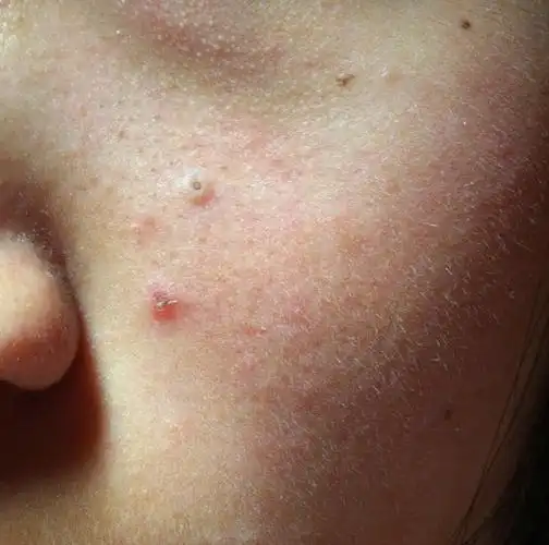 爱美的妹纸伤不起啊!