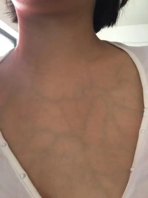 整个前胸,两只胳膊的血管好明显,怎么回事?