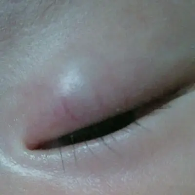 眼皮上长了一个血管瘤,医生说对眼睛没影响.可还是很担心.