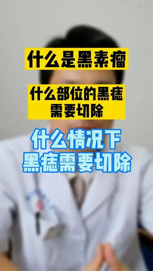 什么是黑素瘤?什么部位的黑痣需要切除?
