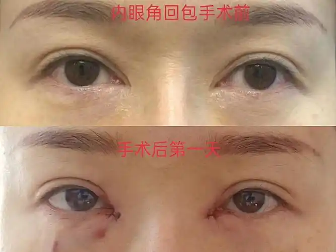 更新一个新鲜出炉的包眼角案例来了