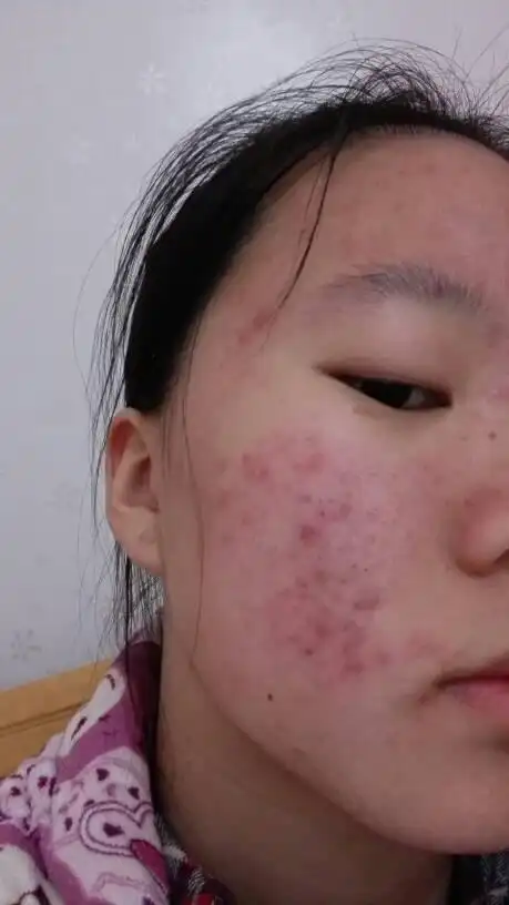 这边脸上是不是得什么炎症了?一直都这样,该怎么办?