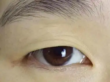 可见上眼皮皮肤过度松弛,萎缩,皮肤变薄,形成下垂状态