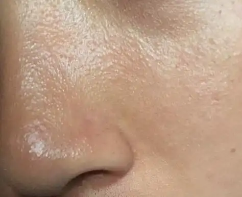 【图】脸上老出油是什么原因? 多种方法帮你彻底解决