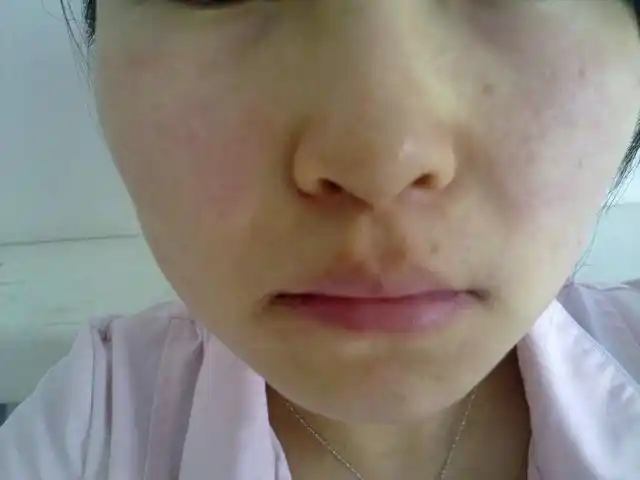 敏感性皮肤不但会红肿,还会对患者心理造成影响,改善和预防很重要