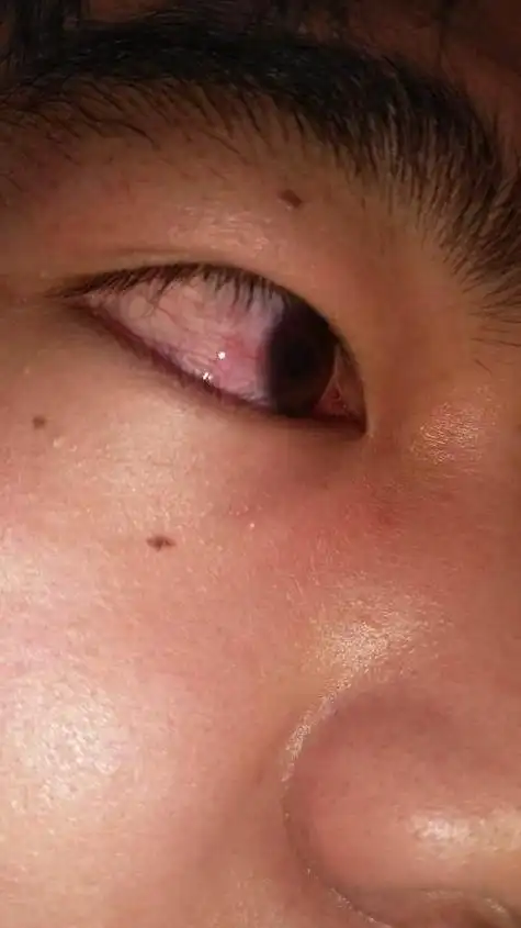 眼睛红血丝_眼睛红血丝预示着什么疾病