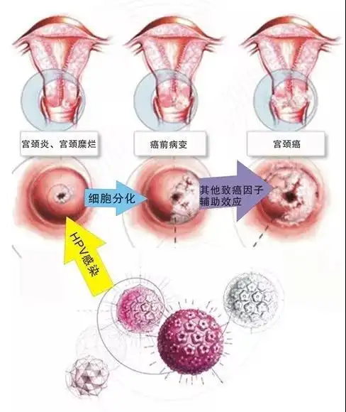 宫颈癌与宫颈疫苗你了解多少