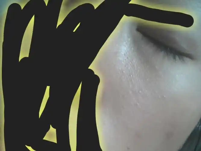 脸上这些小颗粒要怎么去除阿已经长了很多了而且很久都退不掉而且还