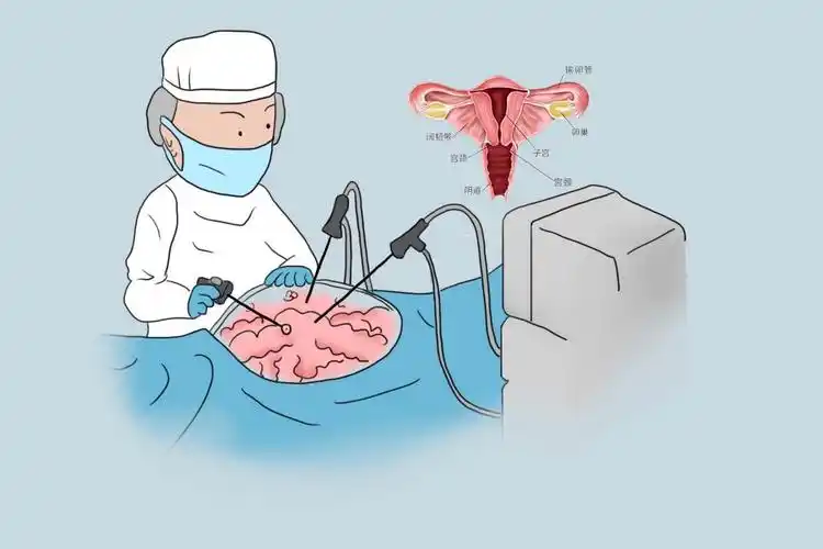 腹腔镜下全子宫切除术图片