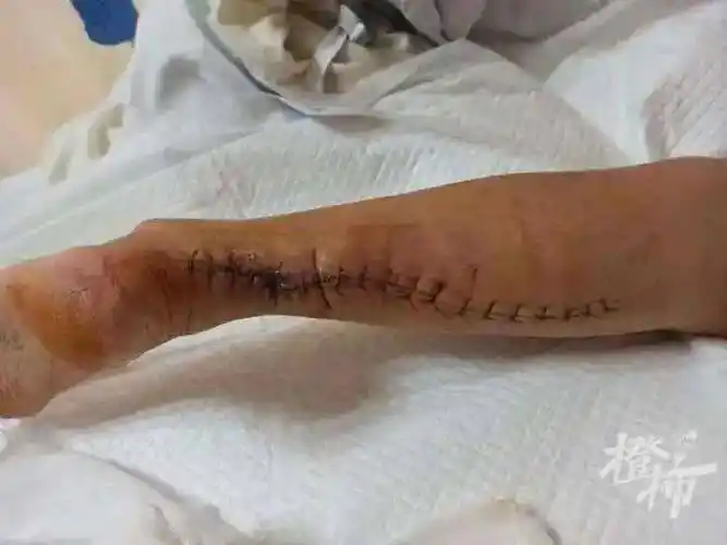 高温天"毛孩子"突然"翻脸",有女子被自家宠物咬伤险截肢