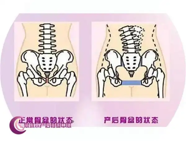 生完孩子身材走形就需要矫正骨盆?不一定哦