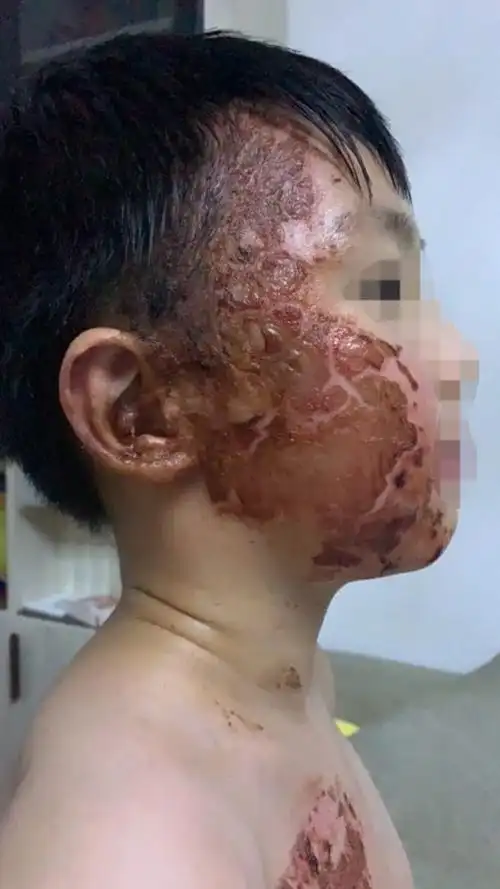 自配纯中药烫伤药治疗在泰国旅游烫伤病例分享