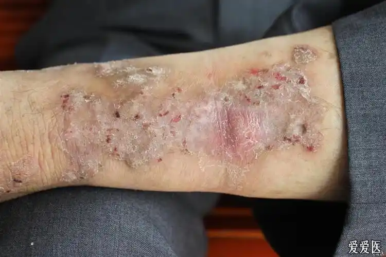 今日遇到的几个皮肤病高清图