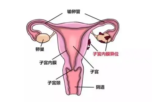 【南昌华儿山生殖医院孕育科普】女性的子宫内膜异位了,怀孕的几率还