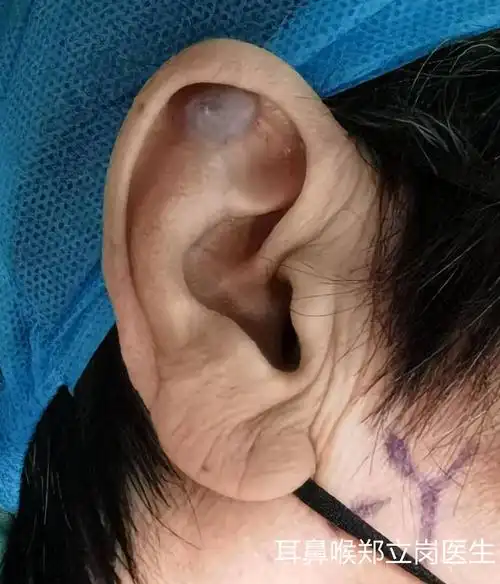 耳廓肿物,切除后修复是关键_耳疾病_相关疾病_介绍 - 好大夫在线